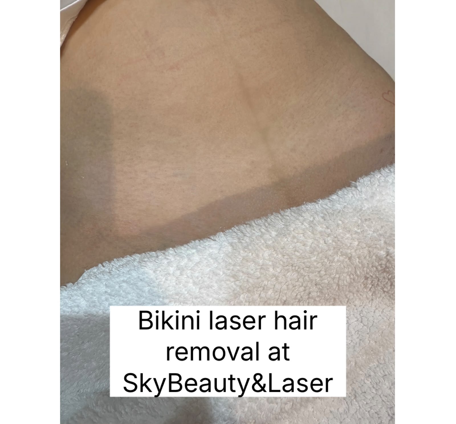Before and after laser hair removal treatment result